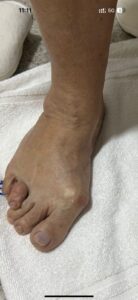 Deformidade dos dedos