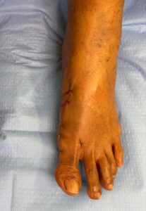 Pós operatório de Joanete